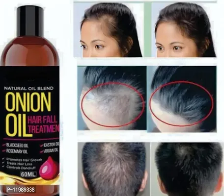 Best Onion Oil for Fast Hair Regrowth  Stopping Hair Fall Oil-60ml--thumb0