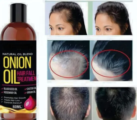 Onion Hair Oil For Hair Regrowth And Prevent Hair Loss