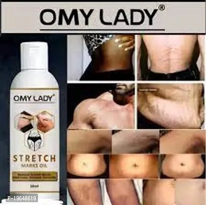 omy lady strech marks oil 50ml (pack of 1)