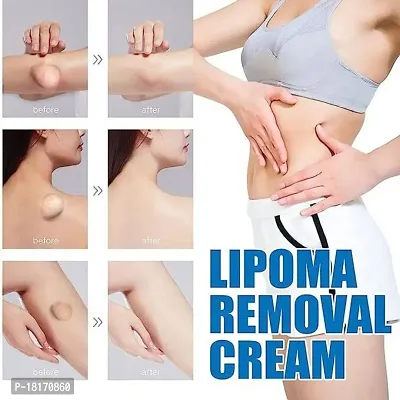 Lipoma Removal Cream Whole Body Lipoma Lump Fat Removal