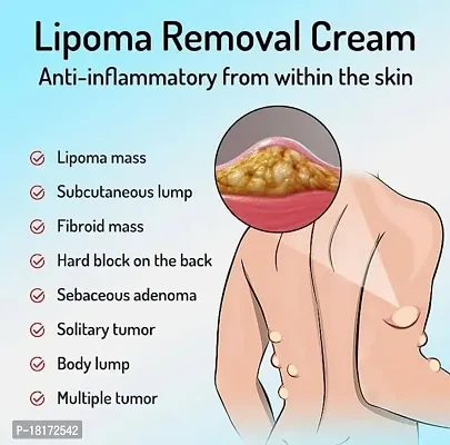 Lipoma Removal Cream Whole Body Lipoma Lump Fat Removal (20 g) (20 g)