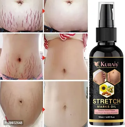 Kuraiy 100%  Repair Stretch Marks Removal - Natural Heal Pregnancy Breast, Hip, Legs