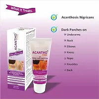 Acantho Cream With Retinol, Lactic Acid  Urea For Skin Discoloration-thumb1