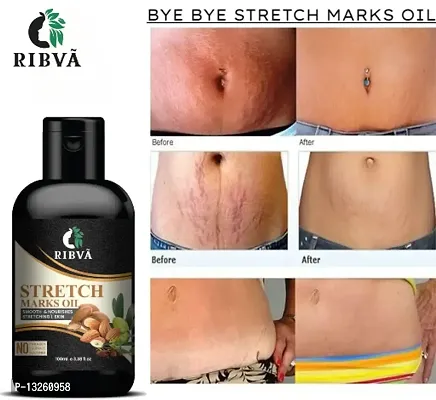 RIBVA present Stretch Marks Removal Oil - Natural Heal Pregnancy, Hip, Legs, Mark oil 100 ml pack of 1