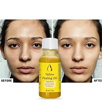 Yellow Peeling Oil Exfoliating Dark Skin for Body, the peeling solution 50 ml-thumb3