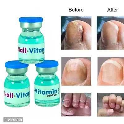 Home Remedies for Fungal Nail Infection - YouTube