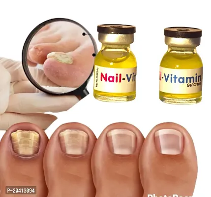 nail fungal treatment, nail serum fungal infection, nail antifungal solution, nail care serum repair, onychomycosis repair nail serum (5ml x 2 pcs )