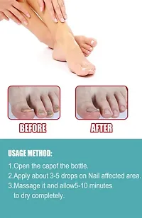 nail fungal infection drop, nail fungus treatment serum, toe nail fungus ointment, onychomycosis repair liquid, nail setter (10ml x 2 pcs )-thumb1