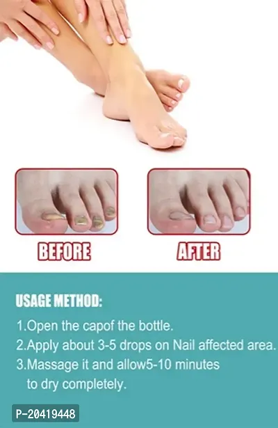 nail fungal infection drop, nail fungus treatment serum, toe nail fungus ointment, onychomycosis repair liquid, nail setter (10ml x 2 pcs )-thumb2