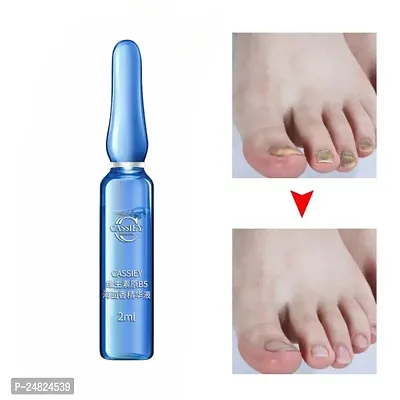 Ginger nail polish Nail Treatment Fungal Nail Repair Rough nail repair Promote nail growth Anti fungal nail infection