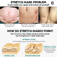 Stretch Marks Removal Cream effectively removes pregnant womenrsquo;s stretch marks-thumb1