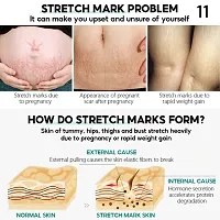 Women Pregnancy Maternity Body New Old Stretch Mark Removal Cream Increase Elasticity of Skin-thumb1