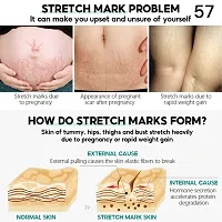 Stretch Marks Burn Keloid Spot Treat Gel Herbal Smooth Whiten Face Skin Care-thumb1