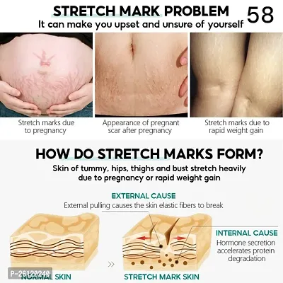 Scar Removal Cream Fast Removal Skin Scars Treat Surgery Scars Stretch Marks-thumb3