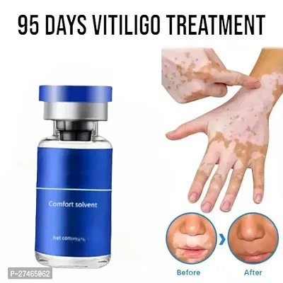 Ayurvedic remedy for pigmentation in Vitiligo/ Leukoderma cream 95 days treatment 10ml (1 pcs)-thumb0