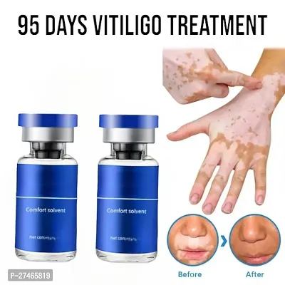 White Spot Removal Skin Vitiligo Eliminate Vitiligo, For White patches remove cream 95 days 20ml (2pcs)-thumb0