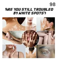 White Spot Removal Skin Vitiligo Eliminate Vitiligo, For White patches remove cream 95 days 20ml (2pcs)-thumb1