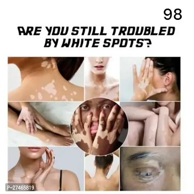 White Spot Removal Skin Vitiligo Eliminate Vitiligo, For White patches remove cream 95 days 20ml (2pcs)-thumb2