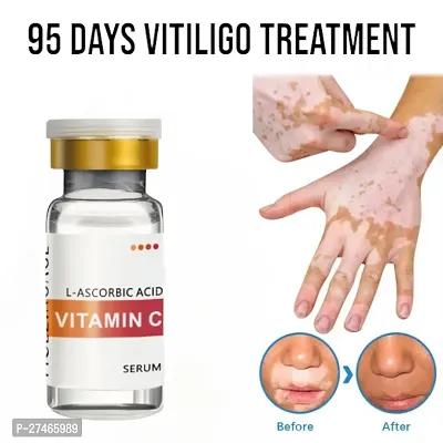 Vitiligo, For White patches, Increase Melanine Secretion, vitiligo cream vitiligo removal cream 95 days treatment 10ml(1pcs)