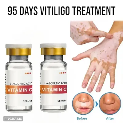 Ayurvedic remedy for pigmentation ,vitiligo relief ointment cream 95 days treatment  20ml (2pcs)