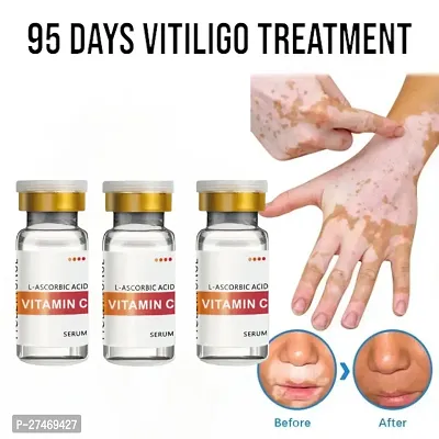 Vitiligo Ointment To Remove Ringworm Herbal CREAM 95 Days 30ml (3 pcs)