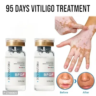 Vitiligo Ointment Herbal GEL Remove Ringworm 95  DAYS 20ml (2 pcs)-thumb0