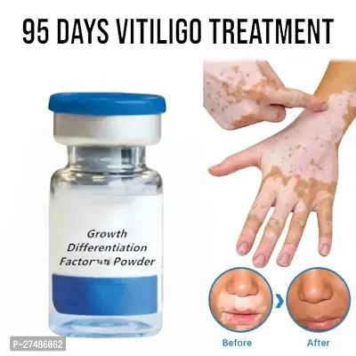 Vitiligo Repair Whole Body Skin White Spot Elimination Products Cream 95 Days 10ml (1 pcs)