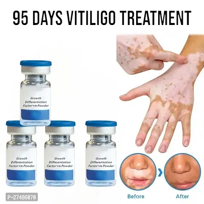 Skin treatment soothing White Spot Removal Vitiligo Care For Adults Cream 95 days 40ml (4 pcs)-thumb0