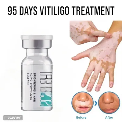 Vitiligo Ointment Remove Ringworm White Spot Removal Skin White Spot Cream 95 days 10ml(1 pcs)-thumb0
