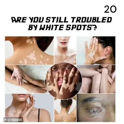 Vitiligo Ointment Remove Ringworm White Spot Removal Skin White Spot Cream 95 days 10ml(1 pcs)-thumb2