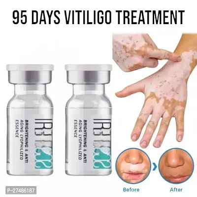 Herbal Extract Vitiligo Ointment Remove Ringworm White Spot Cream 20ml (2 pcs)