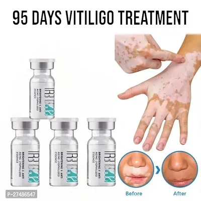 Effectively Remove Vitiligo White Spots Fades Skin Marks Skin Vitiligo Care For Adults 95 Days 40ml(4 pcs)-thumb0