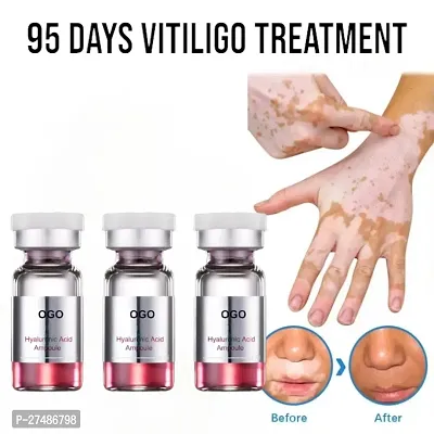 Removal Skin Vitiligo Eliminate Vitiligo Treatment Cream 95 days 30ml (3pcs)