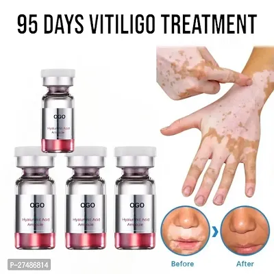 Vitiligo Cream Leukoplakia Treatment Repair Bleaching Gel 40ml (4 pcs)-thumb0