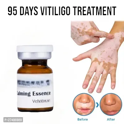 White Spot Removal Skin Vitiligo Eliminate Vitiligo Cream 95 Days 10ml (1pcs)-thumb0
