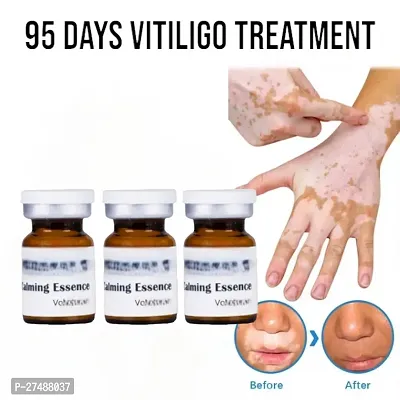 south moon vitiligo treatment ointment Leukoplakia Treatment Cream Repair Bleaching 30ml (3pcs)-thumb0
