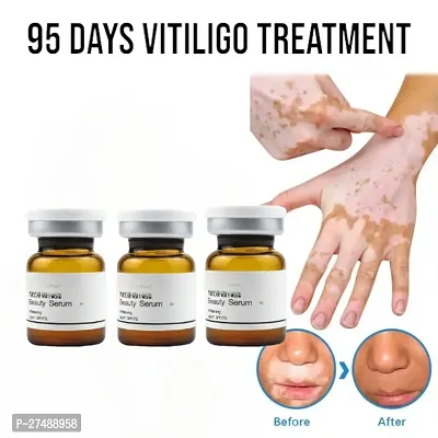 Vitiligo Skin Care Leukoplakia Cream Herbal Extract White Spot Removal Skin Reduce Melanin 95 days 30ml (3pcs)