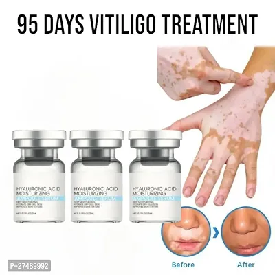 vitiligo cream/ vitiligo removal cream/ vitiligo treatment south moon/ vitiligo treatment ointment 95 days 30ml (3pcs)