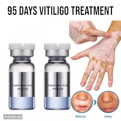 Repair Leukoplakia Reduce Pigment Melanin Antibacterial Moisturing Skin Care Vitiligo Cream 95 days 20ml (2pcs)-thumb0