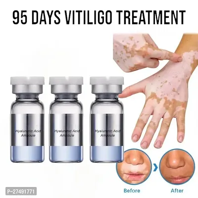 Ayurvedic remedy for pigmentation in Vitiligo/ Leukoderma Cream 95 days 30ml (3pcs)