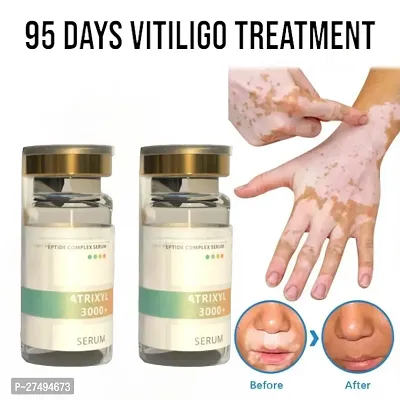 Vitiligo Ointment To Remove Ringworm White Spots Skin Removal Cream 95 days treatment 20ml (2pcs)