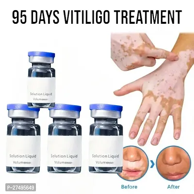 Leukoplakia Disease Cream Vitiligo relief spray Skin treatment 95 days 40ml (4pcs)