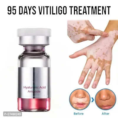 Herbal Vitiligo Ointment Remove Ringworm White Spot Removal Cream 95 days 10ml (1pcs)-thumb0