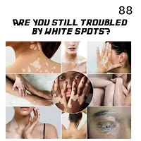 Herbal Vitiligo Ointment Remove Ringworm White Spot Removal Cream 95 days 10ml (1pcs)-thumb1