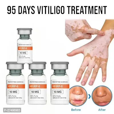 Repair Leukoplakia Vitiligo White Spot Cream Skin Care Vitiligo relief spray 95 days 40ml (4pcs)