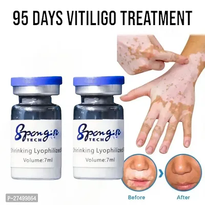 Vitiligo treatment cream Vitiligo derma relief Skin treatment 95 days 20ml (2pcs)