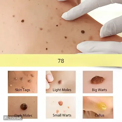 Natural Skin Care Wart Remover Serum, 5ml-thumb3