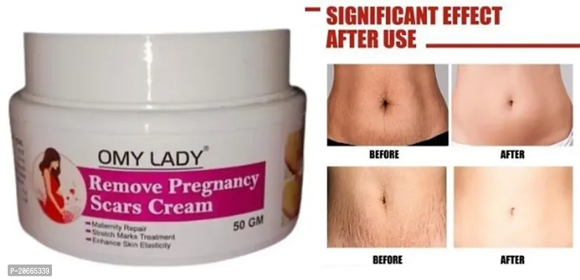 Omy Lady Remove Pregnancy Scars Cream