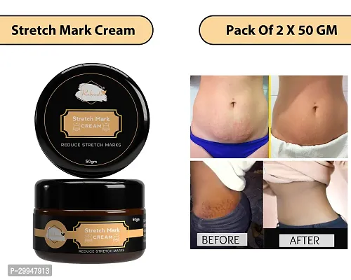 Minimize Stretch Marks Cream, 50gm