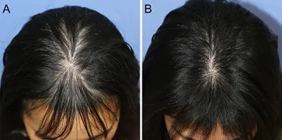 Adivasi Herbal Hair Regrowth  Oil 100 ml Pack Of-2-thumb1